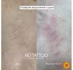 Послуги від центру лазерної та естетичної косметології NO TATTOO