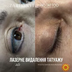 Послуги від центру лазерної та естетичної косметології NO TATTOO